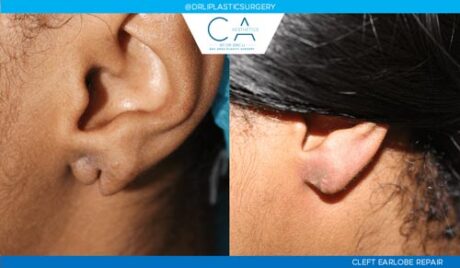 Mole Removal and Scar Revision case #3242