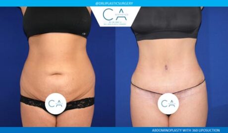 Tummy Tuck case #2603