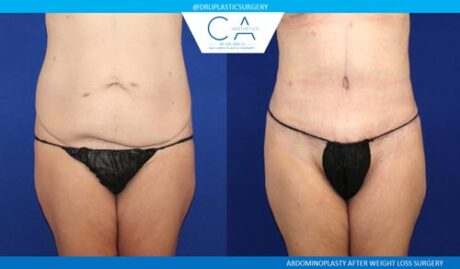 Tummy Tuck case #2607