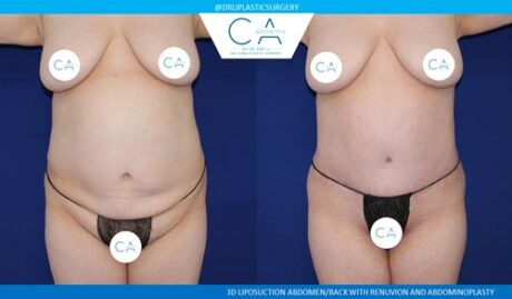 Tummy Tuck case #2612