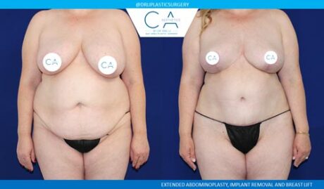 Tummy Tuck case #2616