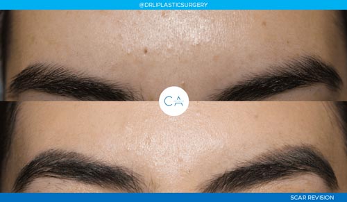 Mole Removal and Scar Revision case #3250