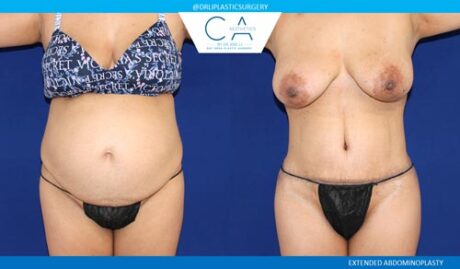 Tummy Tuck case #2621