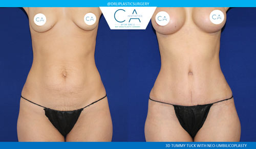 Tummy Tuck case #2624