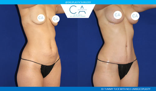 Tummy Tuck case #2624