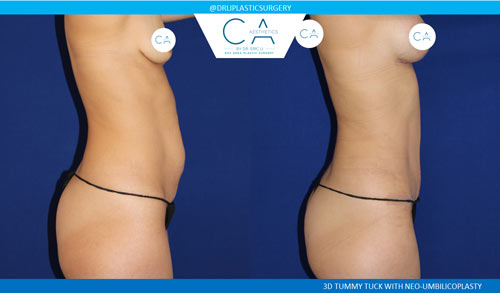 Tummy Tuck case #2624