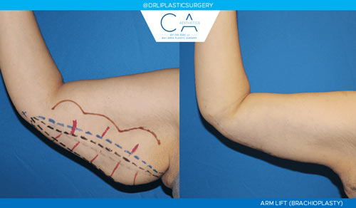 Arm Lift (Brachioplasty) case #2349