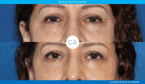 Lower Blepharoplasty (Eyelid Surgery) case #3023