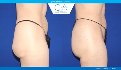 Sculptra Buttock case #3196