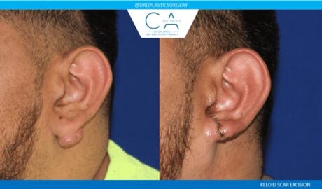 Otoplasty (Ear Surgery) case #3274