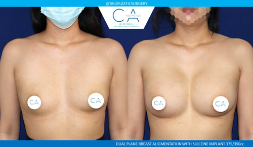 Tuberous Breast Correction case #3470