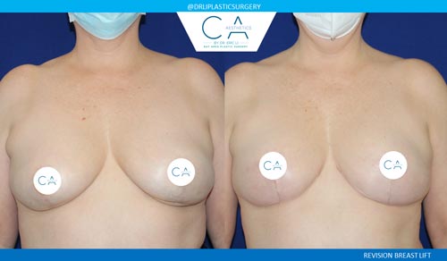 Breast Lift case #3495