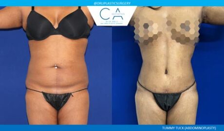 Tummy Tuck case #2536