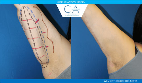 Arm Lift (Brachioplasty) case #2349