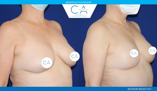 Breast Lift case #3495