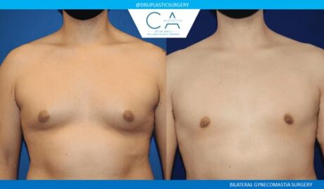 Gynecomastia case #2833