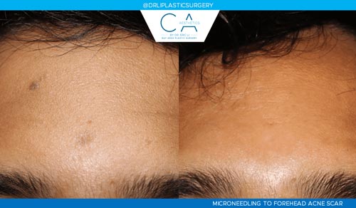 Microneedling case #3177