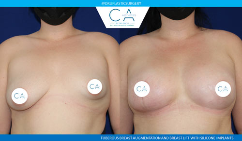 Tuberous Breast Correction case #3474