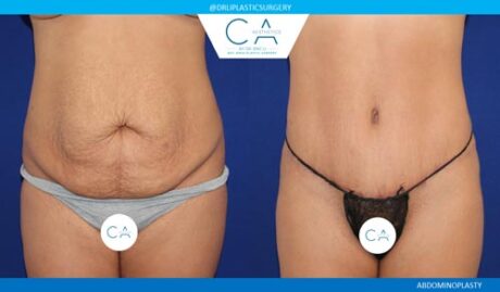 Tummy Tuck case #2540