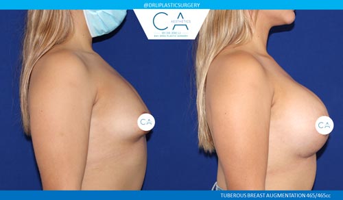 Breast Lift case #3499