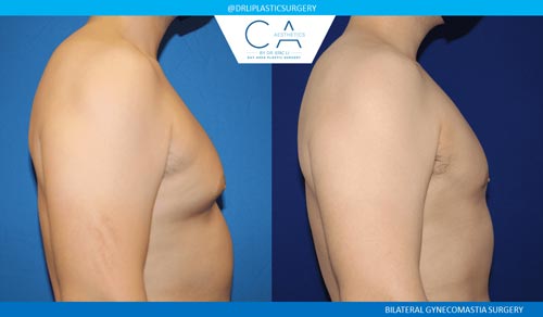 Gynecomastia case #2833