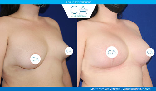 Tuberous Breast Correction case #3474