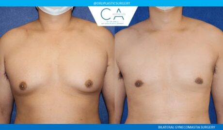 Gynecomastia case #2836