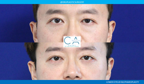 Lower Blepharoplasty (Eyelid Surgery) case #3028