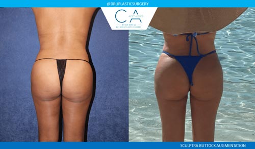 Sculptra Buttock case #3199