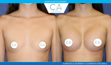 Asian Breast Augmentation case #2448