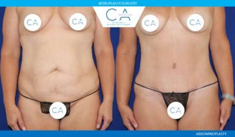 Tummy Tuck case #2545