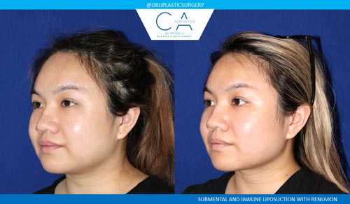 Face & Neck Liposuction case #2770