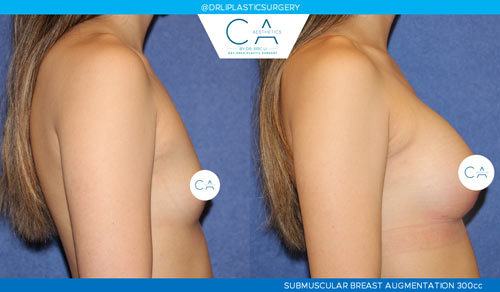 Asian Breast Augmentation case #2448