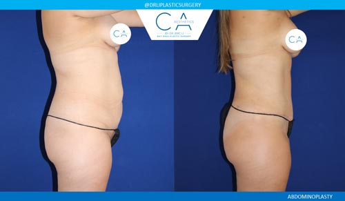 Tummy Tuck case #2545