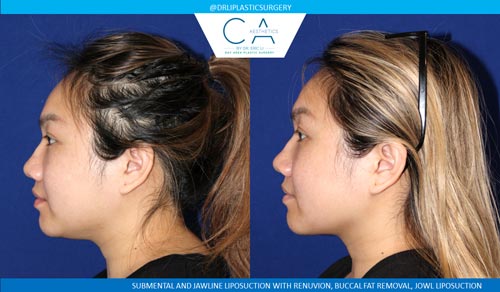 Face & Neck Liposuction case #2770