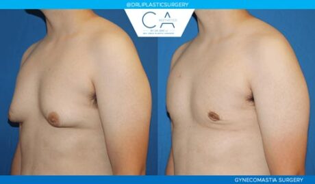 Gynecomastia case #7657