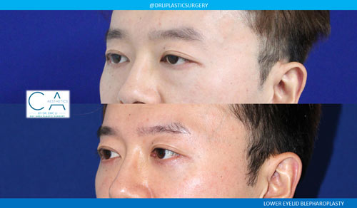 Lower Blepharoplasty (Eyelid Surgery) case #3028