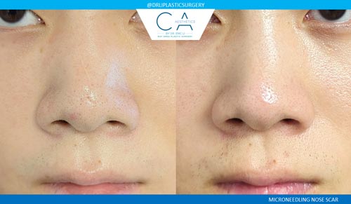 Microneedling case #3181