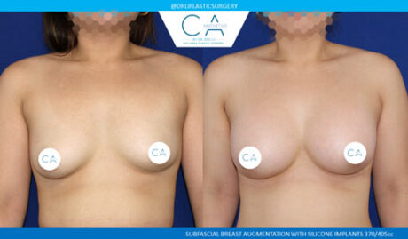 Tuberous Breast Correction case #3481