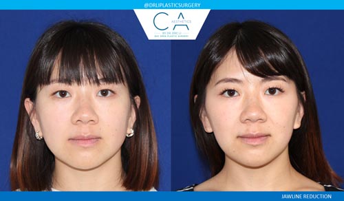 Asian Jawline Reduction case #2386