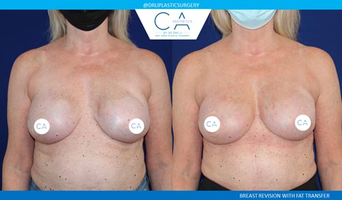 Breast Revision case #3731