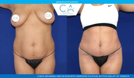 Tummy Tuck case #2548