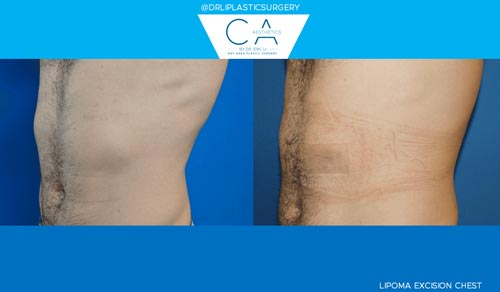 Mole Removal and Scar Revision case #3215