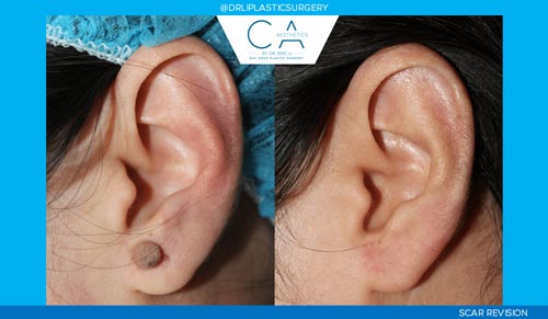 Otoplasty (Ear Surgery) case #3282