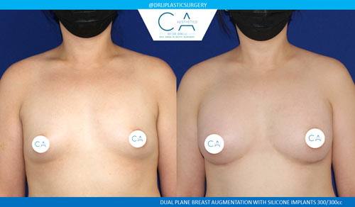 Tuberous Breast Correction case #3485