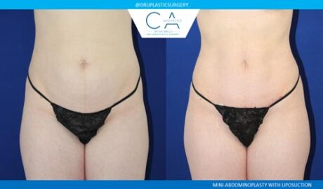 Tummy Tuck case #2552