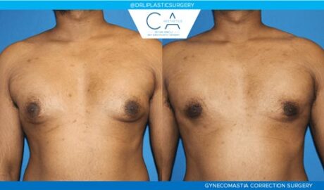 Gynecomastia case #2842