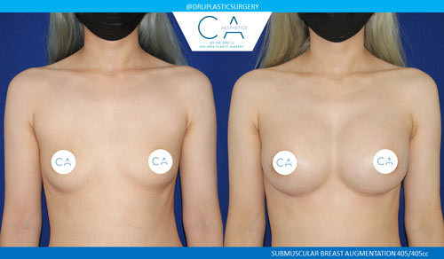 Asian Breast Augmentation case #2455