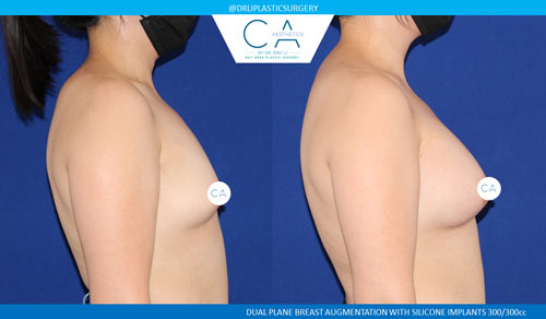 Tuberous Breast Correction case #3485