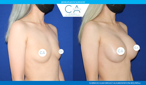 Asian Breast Augmentation case #2455